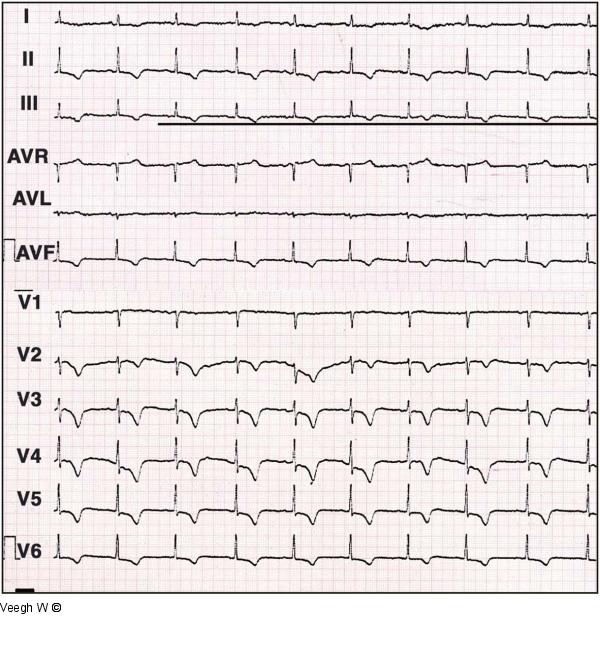 EKG