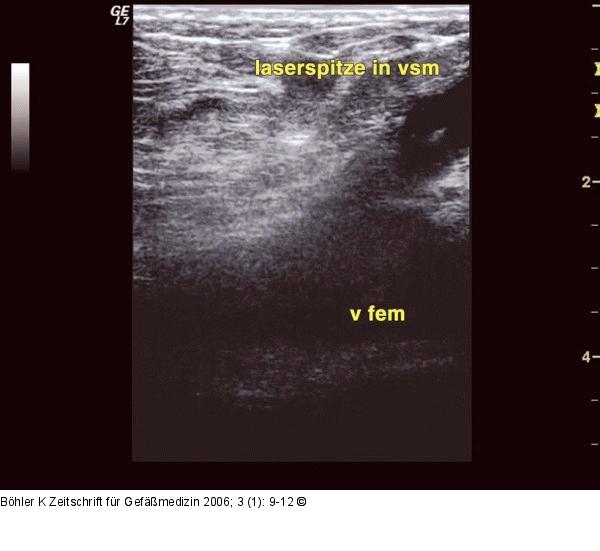Endovenser Laser