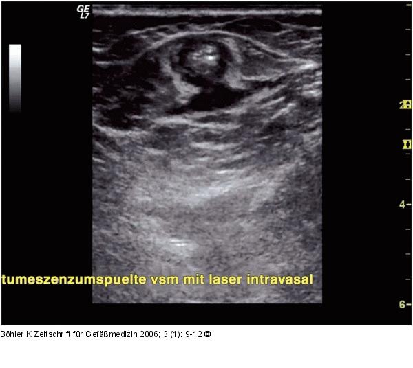 Tumeszenzlokalansthesie