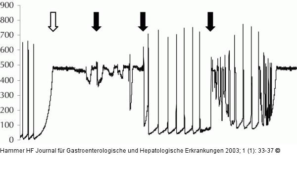 Ileum - Druck