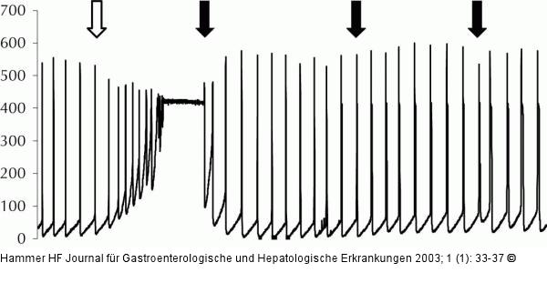 Ileum - Druck