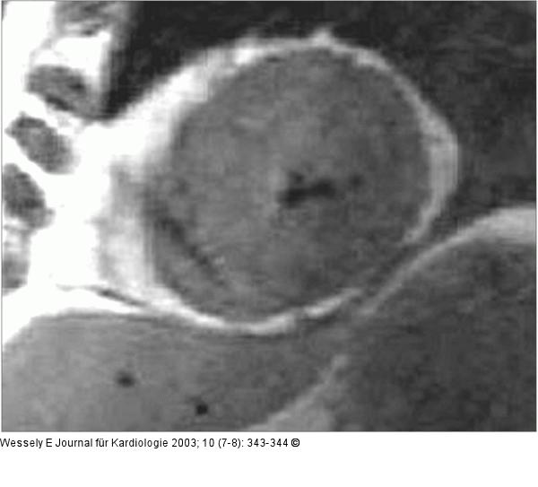 Hypertrophische Kardiomyopathie
