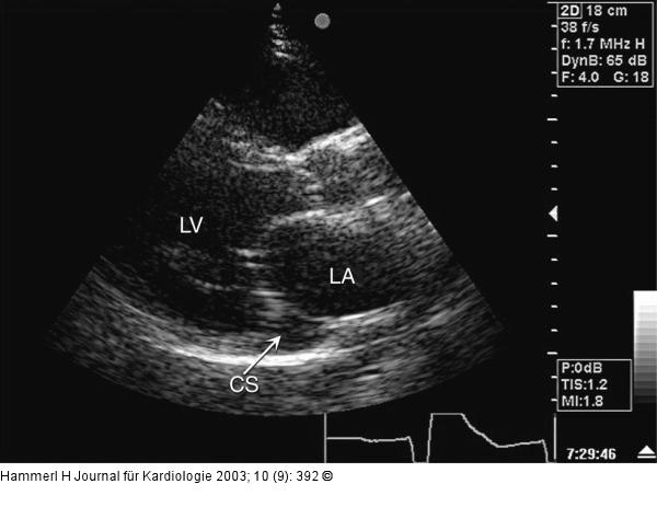 Vena cava superior sinistra persistens
