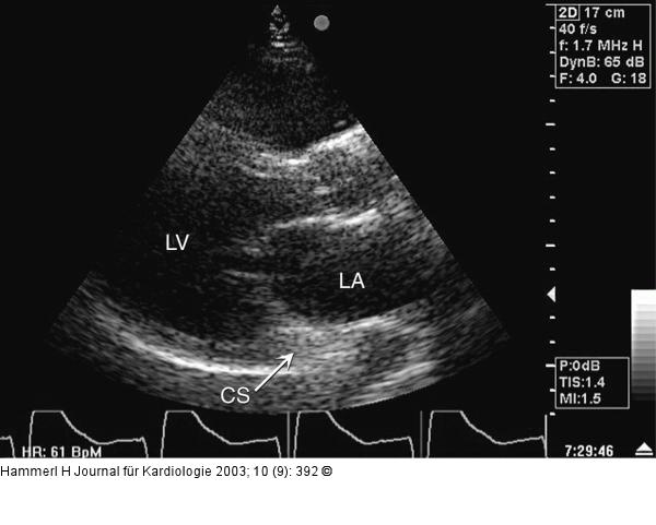 Vena cava superior sinistra persistens