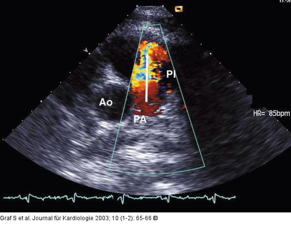 Pulmonalklappenendokarditis