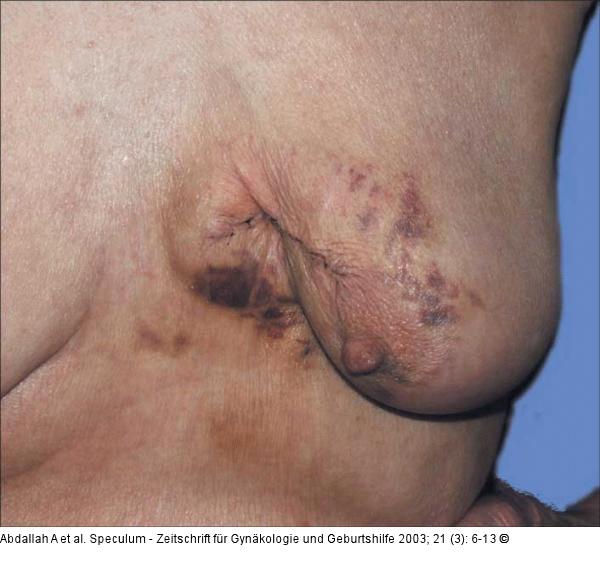 Brusterhaltung - Kosmetische Chirurgie