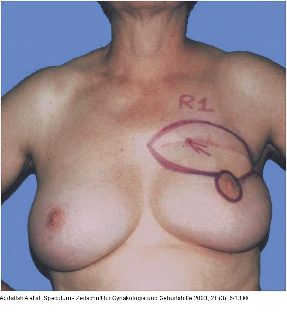 Brusterhaltung - Kosmetische Chirurgie