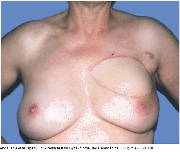 Brusterhaltung - Kosmetische Chirurgie