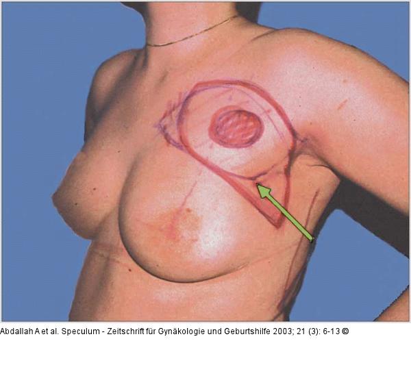 Brusterhaltung - Kosmetische Chirurgie