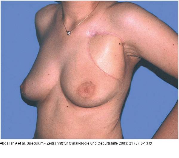 Brusterhaltung - Kosmetische Chirurgie