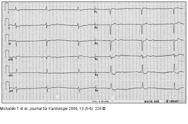 EKG
