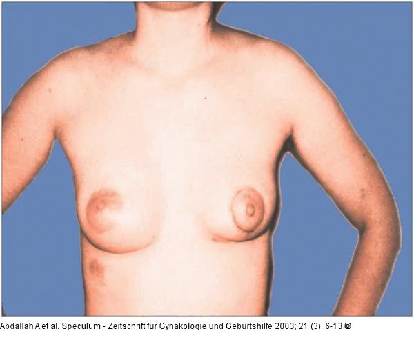 Brusterhaltung - Kosmetische Chirurgie