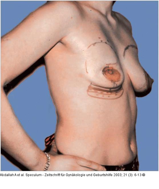 Brusterhaltung - Kosmetische Chirurgie