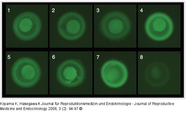 POF - oocytes