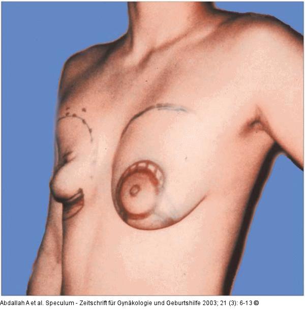 Brusterhaltung - Kosmetische Chirurgie