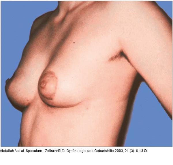 Brusterhaltung - Kosmetische Chirurgie
