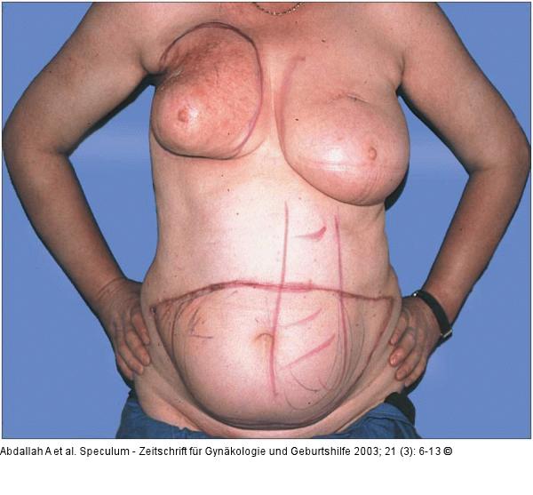 Brusterhaltung - Kosmetische Chirurgie