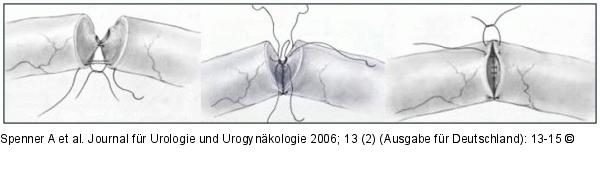 Anastomosennaht