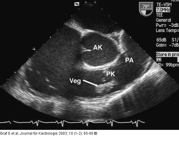 Pulmonalklappenendokarditis