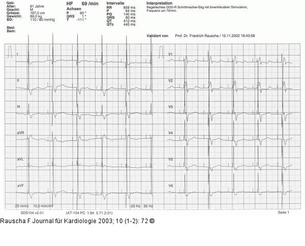Schrittmacher-EKG