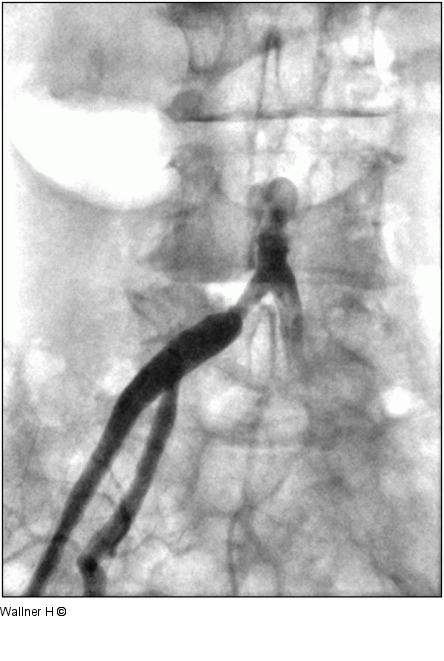 Aortenbifurkationsstenose