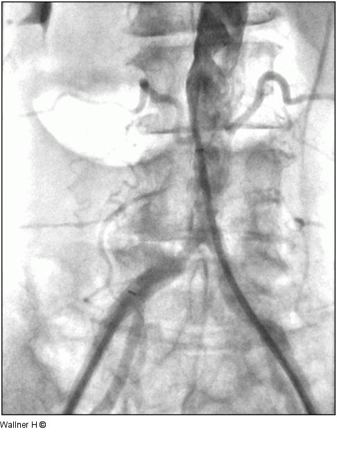 Aortenbifurkationsstenose