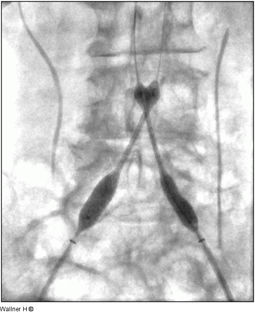 Kissing-Stenting