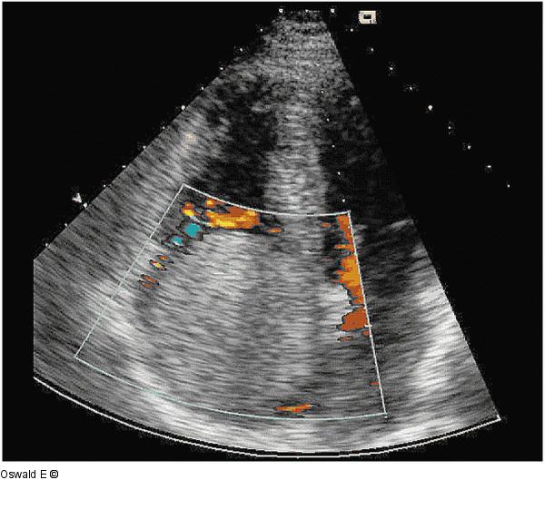 Tumor - Ventrikulre Interaktion