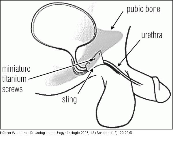 In-Vance-System