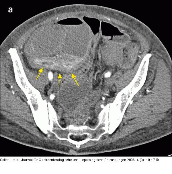 CT-Enteroklysma