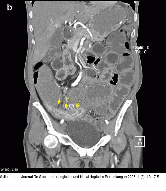 CT-Enteroklysma