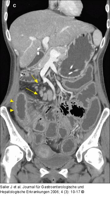 CT-Enteroklysma
