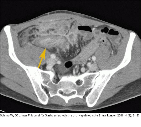 MDCT - Ileum