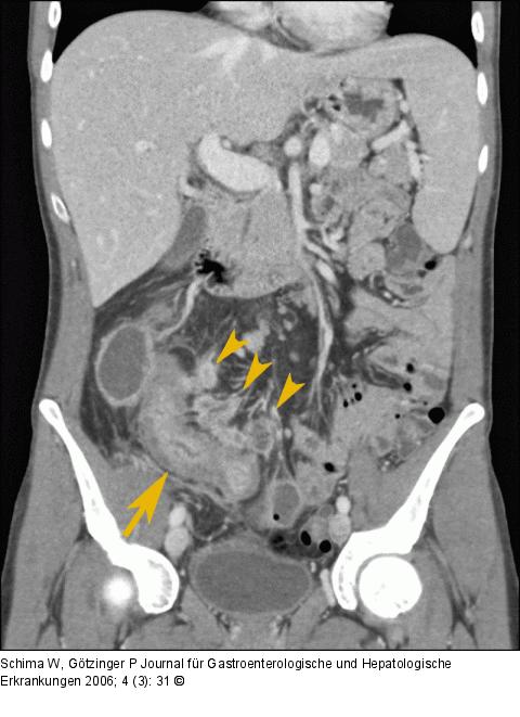 Ileum - Mesenterium