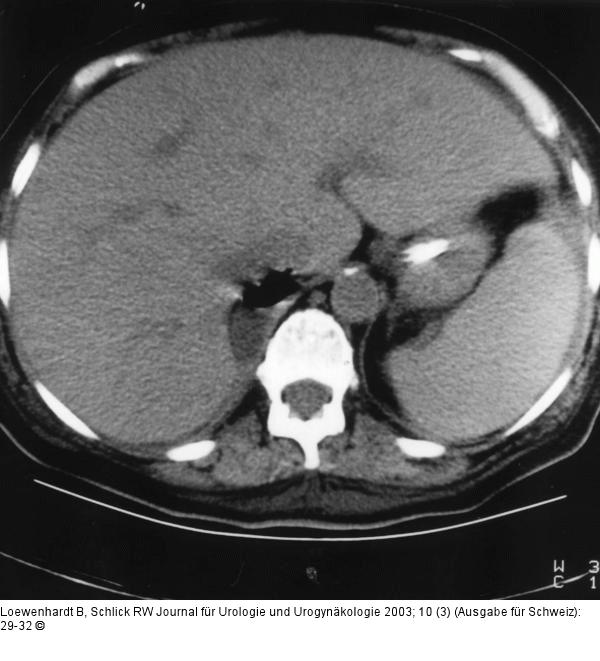 Emphysematse Pyelonephritis