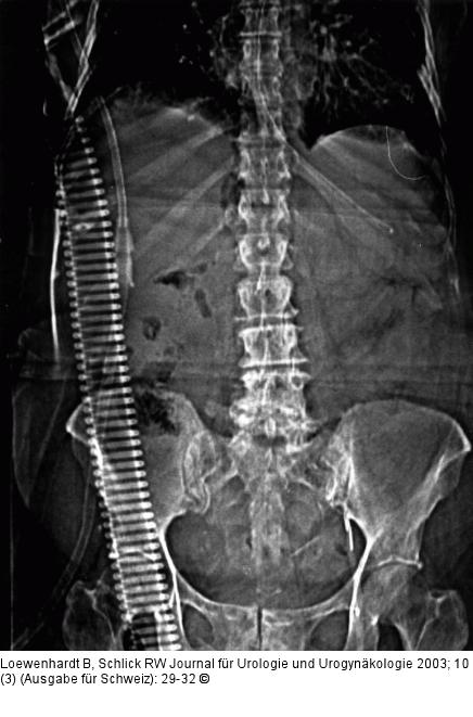 Emphysematse Pyelonephritis