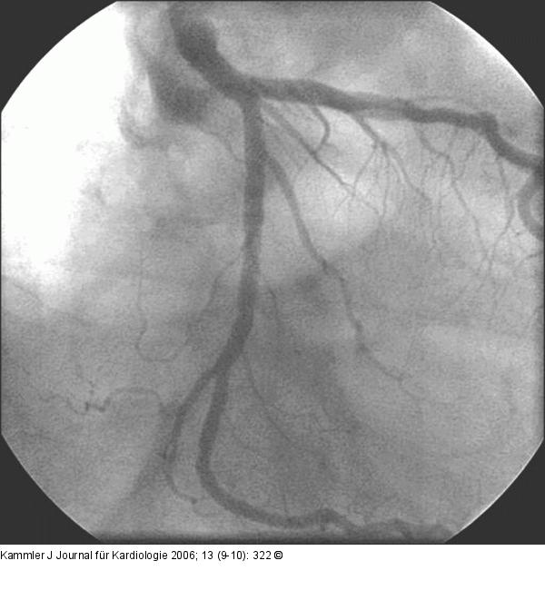 Angiogramm - PCI