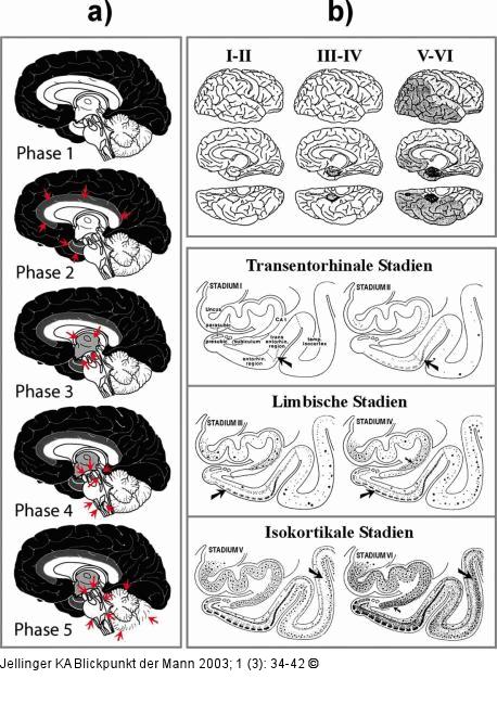 Alzheimer - Pathologie