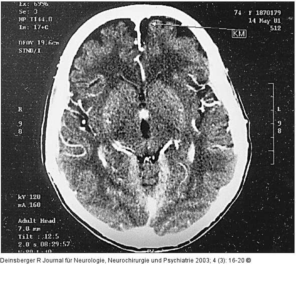 Hypernephrom-Metastase