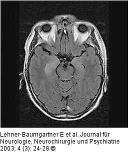 Nichtneoplastische limbische Enzephalitis