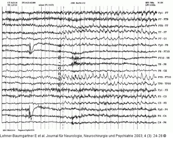 Nichtneoplastische limbische Enzephalitis