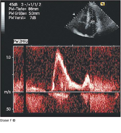 Mitralisdoppler