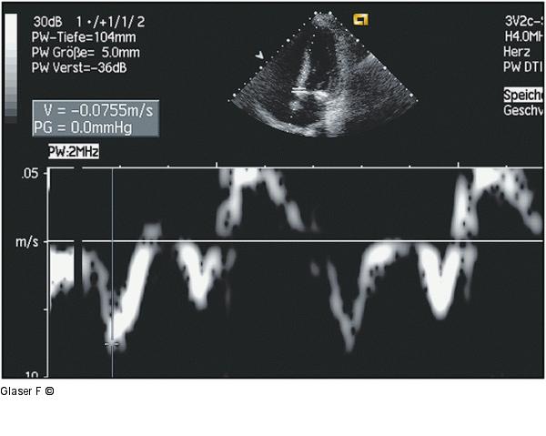 Gewebedoppler