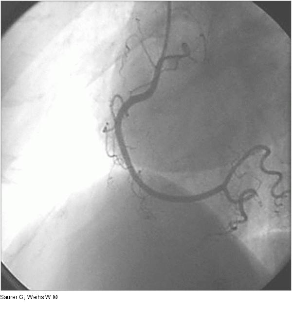 Angiogramm - Koronararterie