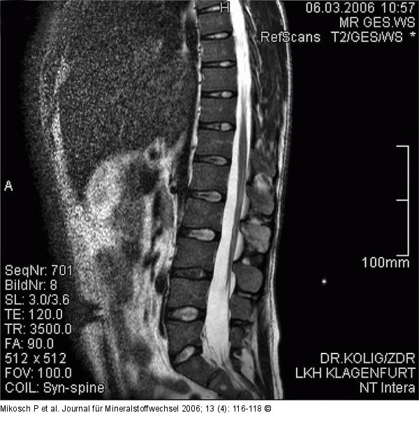 MRI - LWS