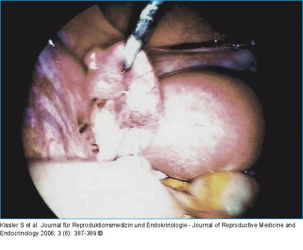 Ectopic pregnancy