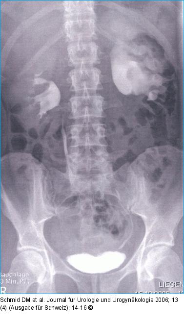 Abgangsstenose
