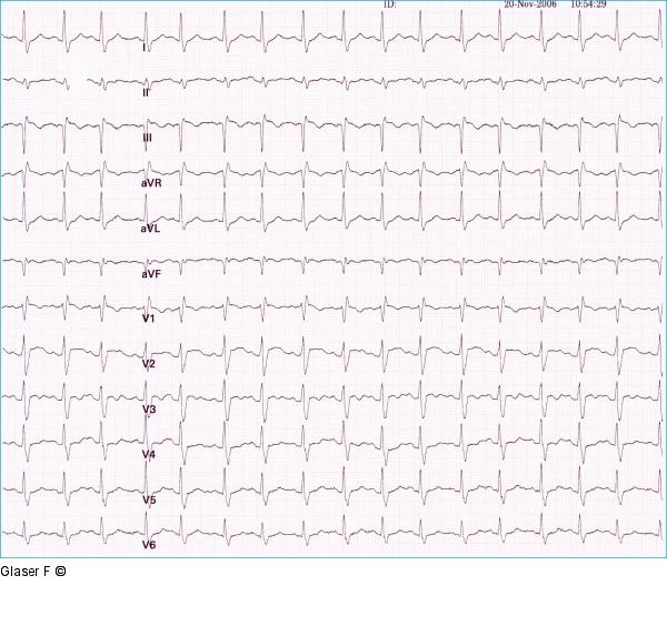 EKG - Lysetherapie