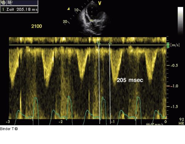 Aortales elektromechanisches Delay