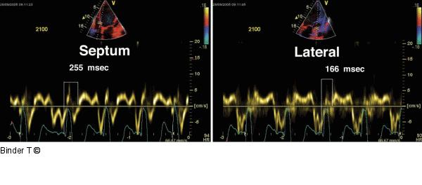 PW-Gewebedoppler (Septum/lateral)